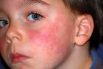 Алергія на сонце: причини, профілактика і лікування